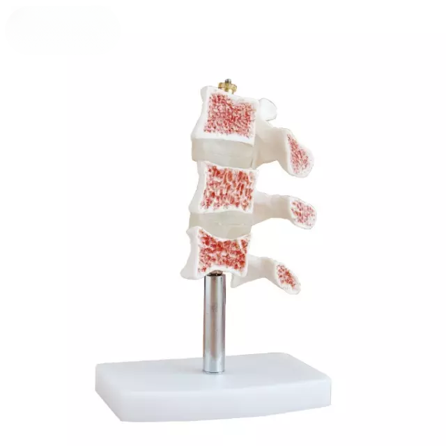 Modelo de osteoporosis seccionado